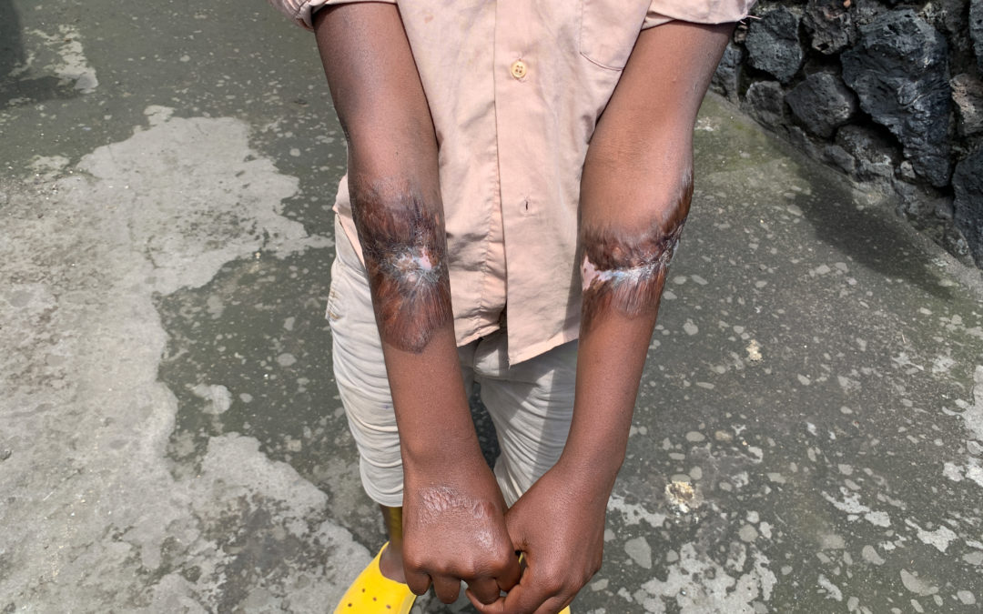 Ma belle-mère m’a brûlé les bras