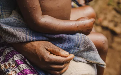 Est-ce que la Mpox remplace le Covid ?