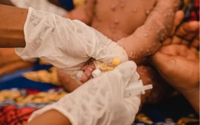 Comment réagir face aux symptômes de la mpox ?