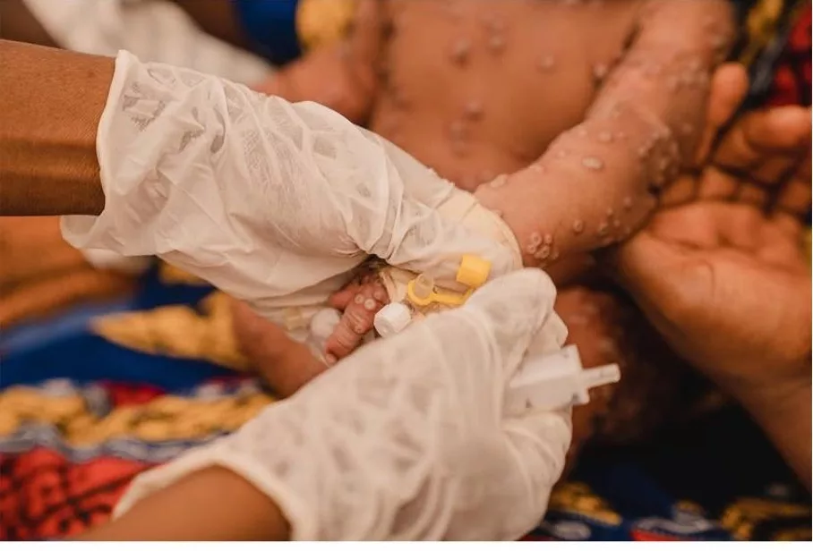 Durant le traitement contre la mpox