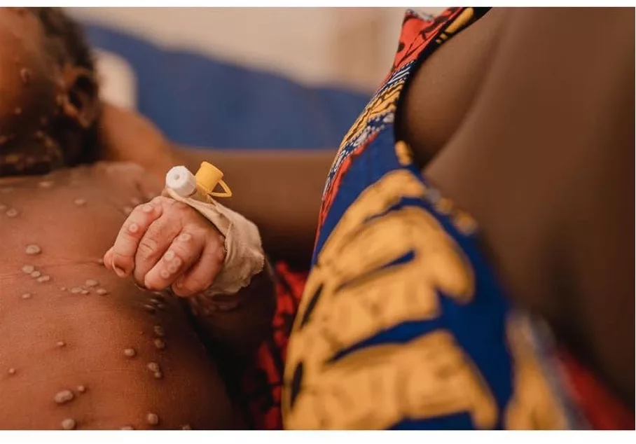 Ensemble protégeons les enfants de la mpox